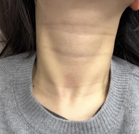 橫向頸紋