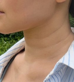 科技頸紋