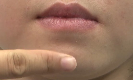 （承漿穴位置）